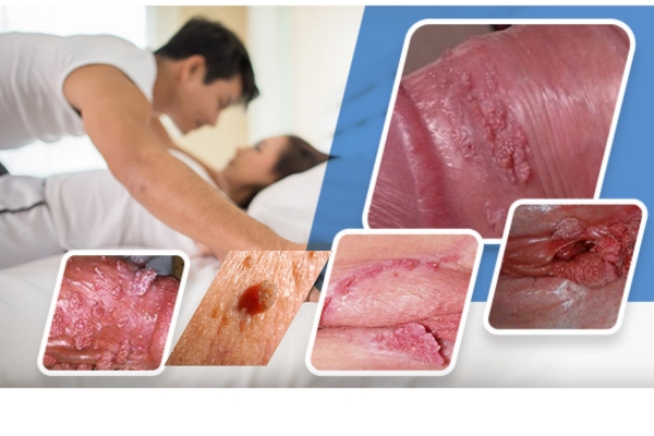 sui-mao-ga-cach-dieu-tri