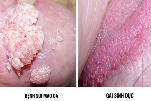 sui-mao-ga-va-gai-sinh-duc