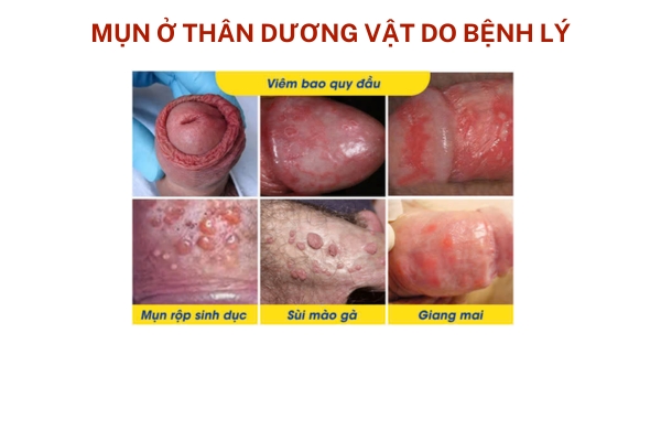 nguyen-nhan-noi-mun-o-than-duong-vat