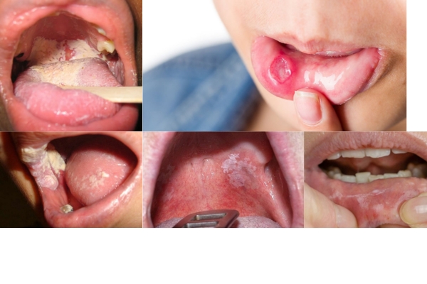 dau-hieu-benh-lau-o-mieng