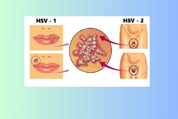 benh-herpes (2)