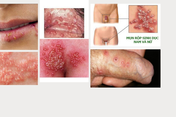 dau-hieu-mun-rop-sinh-duc-can-biet