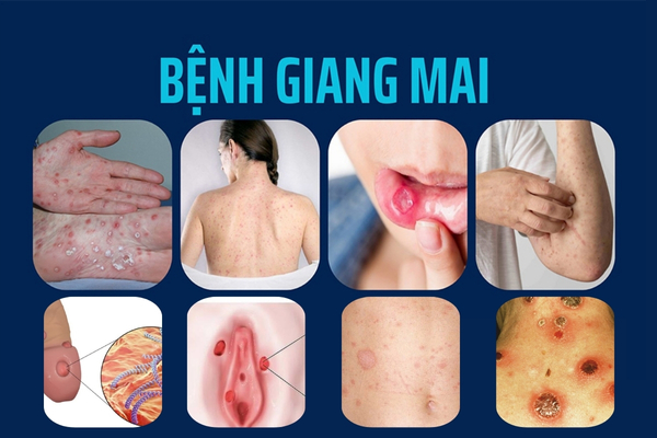 giang-mai-nguy-hiem