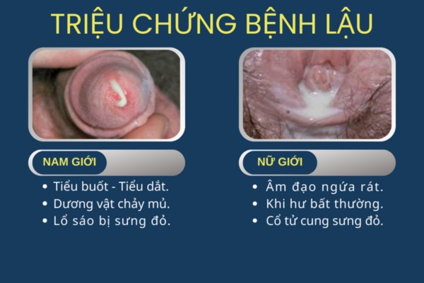 trieu-chung-benh-lau-the-nao