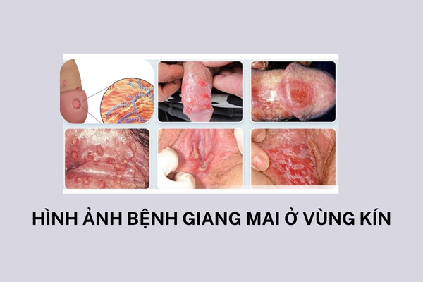 Bệnh giang mai ở vùng kín có biểu hiện gì nguy hiểm không?