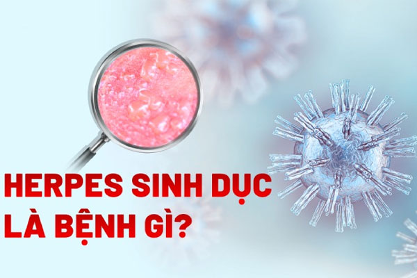 Bệnh Herpes sinh dục là gì? Triệu chứng, tác hại và cách chữa trị hiệu quả