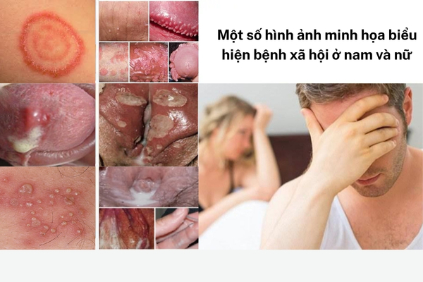 benh-xa-hoi-trieu-chung