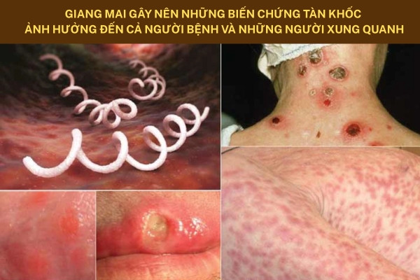 bien-chung-benh-giang-mai-nguy-hiem