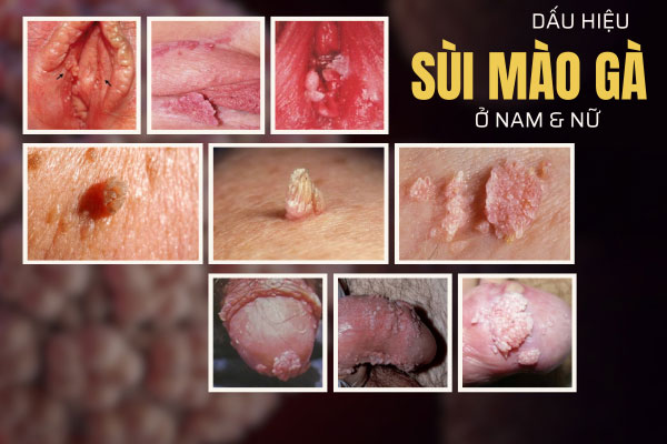 bieu-hieu-sui-mao-ga