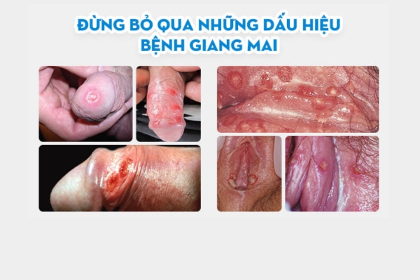 dau-hieu-benh-giang-mai-can-di-xet-nghiem