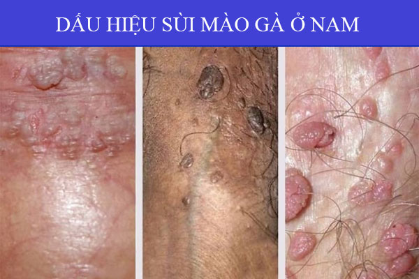 dau-hieu-sui-mao-ga-o-nam