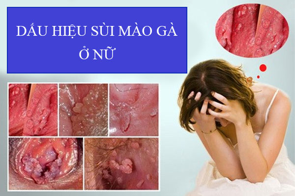 dau-hieu-sui-mao-ga-o-nu