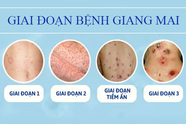 Tất tần tật thông tin về bệnh giang mai nam nữ cần biết