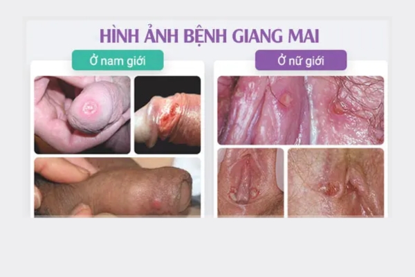 hinh-anh-giang-mai
