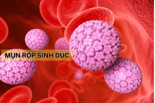 Ngại ngùng không đi khám – Mụn rộp sinh dục âm thầm tàn phá sức khỏe
