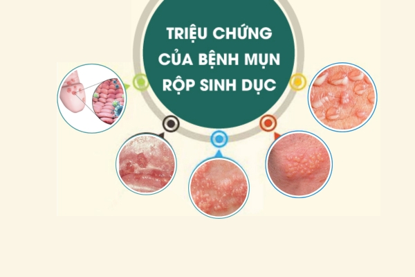 mun-rop-sinh-duc (4)