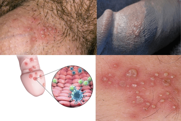 mun-rop-sinh-duc-nam