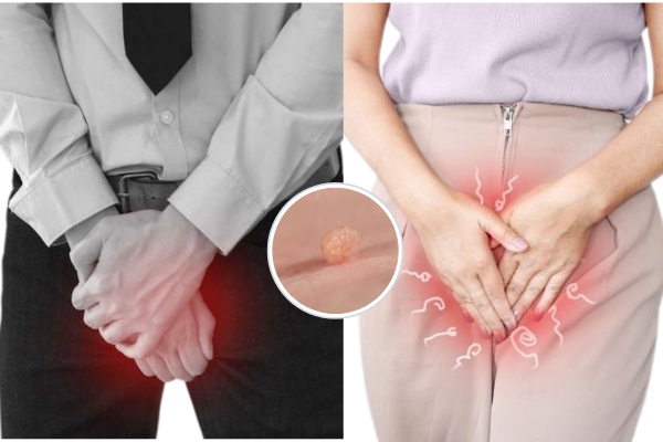 Nổi mụn thịt ở vùng kín là bị gì?