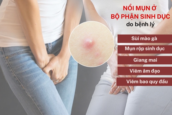 Nguyên nhân nổi mụn ở bộ phận sinh dục và cách điều trị