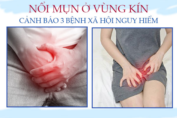 Nổi mụn ở vùng kín nam nữ là bị gì? Cảnh giác với 3 bệnh xã hội nguy hiểm