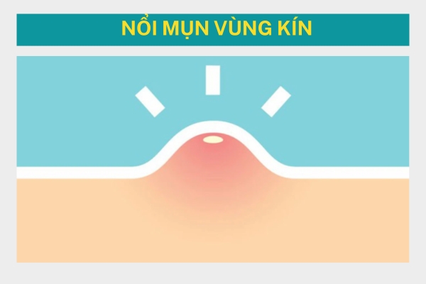 Nổi Mụn Vùng Kín Là Gì? Cách Phân Biệt Mụn Thường Và Bệnh Lý