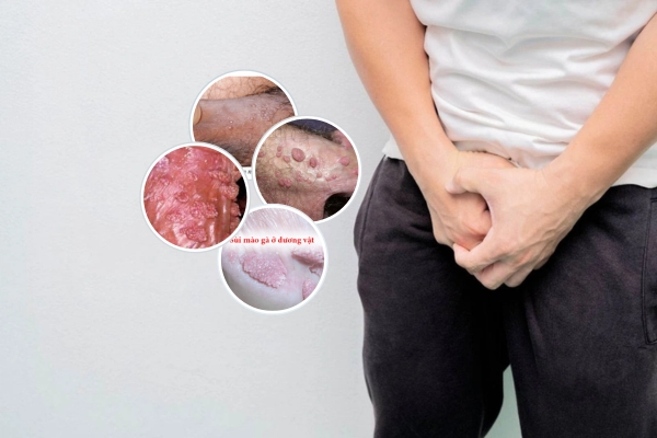 sui-mao-ga-duong-vat