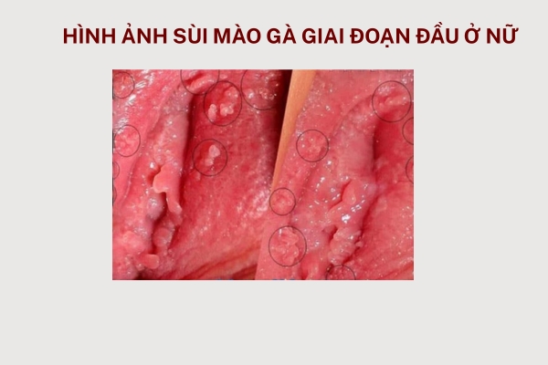 sui-mao-ga-giai-doan-dau (1)