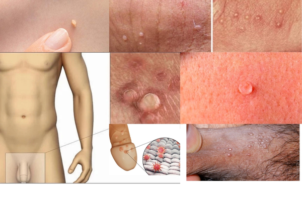 sui-mao-ga-giai-doan-dau