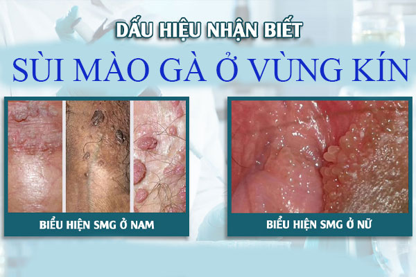 sui-mao-ga-o-vung-kin