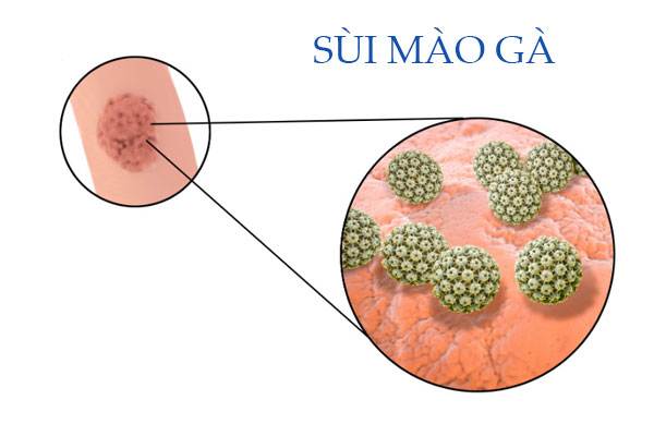Nhận biết sùi mào gà ở hậu môn – Cách điều trị hiện đại