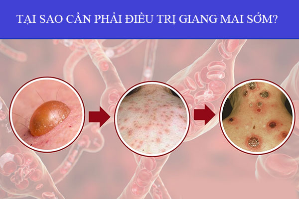 tai-sao-can-phai-dieu-tri-giang-mai-som