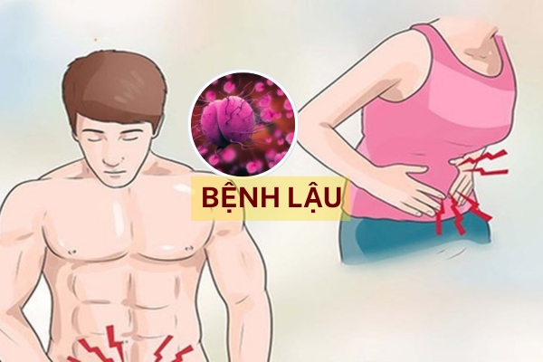 Nghe quen nhưng hiểu sai: Bệnh lậu và 5 sự thật khiến bạn bất ngờ