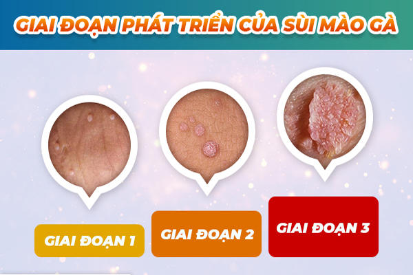 trieu-chung-benh-sui-mao-ga-nam-va-nu