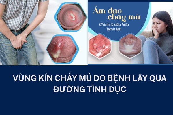 Vùng kín chảy mủ là biểu hiện của bệnh gì? nguy hiểm không?