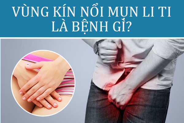 Vùng kín nổi mụn li ti là bệnh gì? Cẩn trọng với những nguy cơ tiềm ẩn