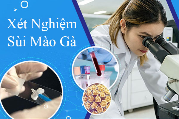 Xét nghiệm sùi mào gà là gì? Phương pháp và địa chỉ thực hiện uy tín